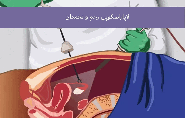 بهترین جراح لاپاراسکوپی رحم و تخمدان